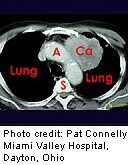 More Evidence Backs Routine CT Scans for Early Lung Cancer Detection