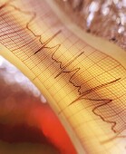 Sudden Cardiac Arrest May Have Early Warning Signs