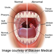 HPV-Linked Throat Cancer May Have Telltale First Symptoms