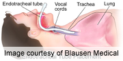 Device May Restore Speech to People on Breathing Tubes