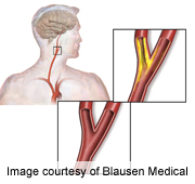 Thinking, Memory Problems Tied to Blockages in Neck Artery