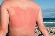 It's Better to Prevent a Sunburn Than to Treat One, Dermatologist Says