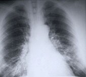 U.S. Lung Cancer Rates Falling Overall, Study Finds