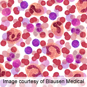 'Biospleen' Suggests New Way to Treat Blood Infection