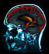 Brain Chemical May Help Control Tourette 'Tics'