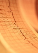 ER Visits for Common Irregular Heartbeat Are Rising, Study Finds
