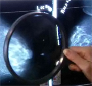 Breast Cancer Vaccine Shows Promise in Early Trial