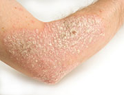 FDA Approves New Psoriasis Drug
