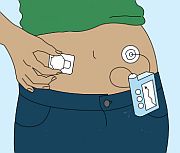 Diabetes Groups Call for Greater Scrutiny of Insulin Pumps