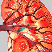 Abnormal Test Results in Hospital Signal Raised Kidney Injury Risk