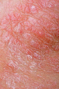 New Drug Shows Promise Against Psoriasis