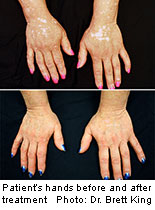 Drug for Rheumatoid Arthritis May Also Help Ease Vitiligo