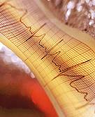 Implanted Defibrillators Restore Healthy Heart Function to Many: Study