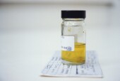 Urine Test Might Find Pancreatic Cancer Early, Study Suggests