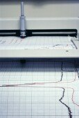 Study: Lowering Beta-Blocker Dose May Boost Survival After Heart Attack
